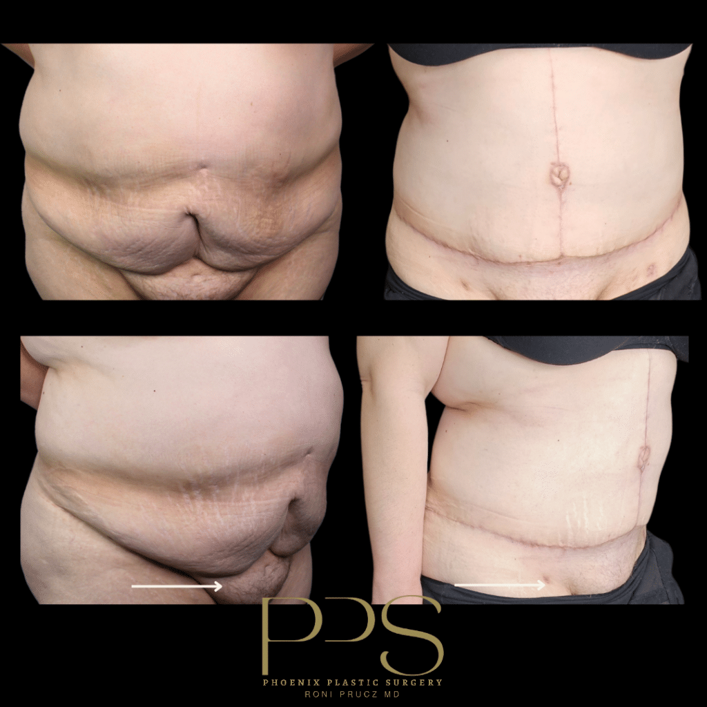 Before and After Photo of Fleur Di Lis Abdominoplasty at Phoenix Plastic Surgery
