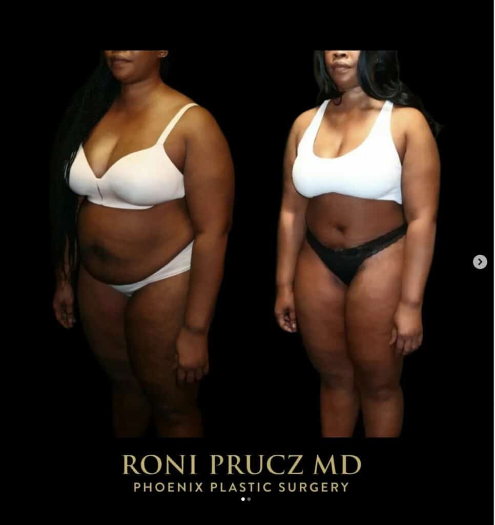 Before and After Photo of Female Abdominoplasty with Rectus Plication Scottsdale Arizona