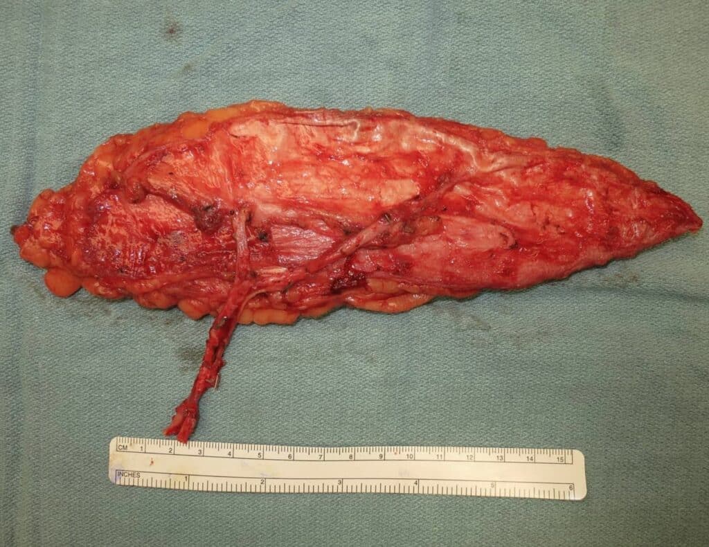 Free Latissimus Muscle Flap with Blood Vessel Pedicle Prior to Transfer