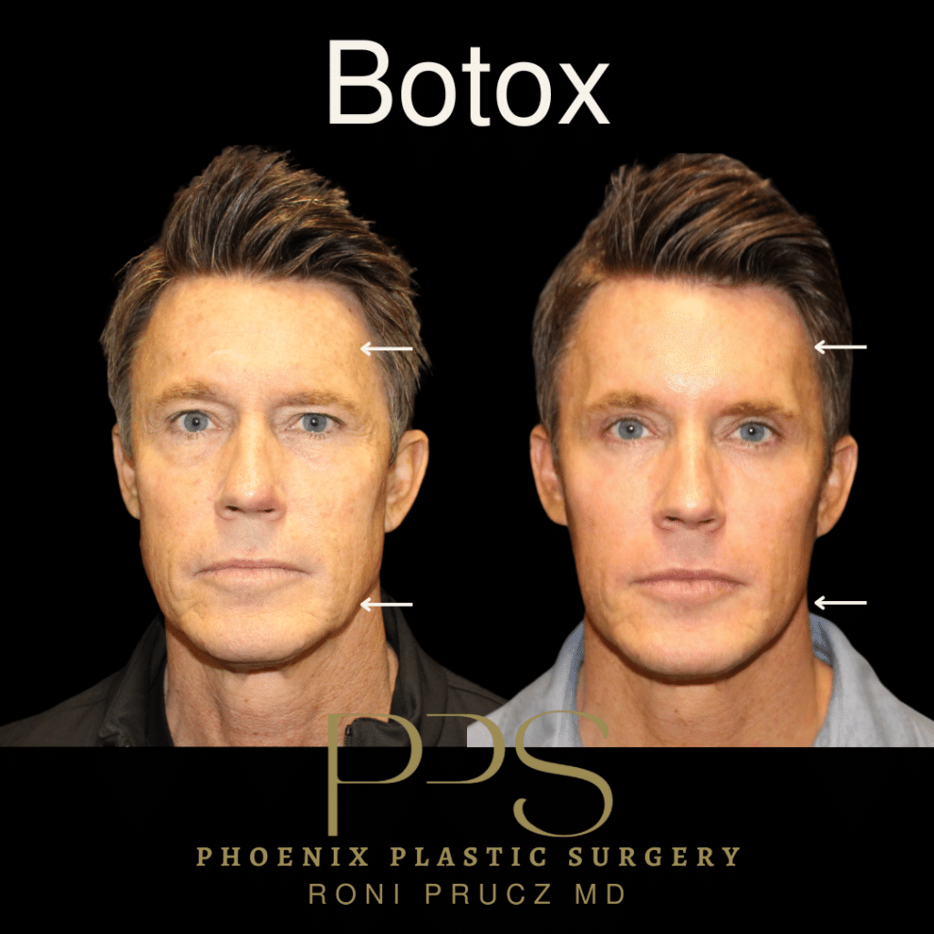 Anterior View of Botox For Forehead and Masseter With Facial Thinning Scottsdale Arizona