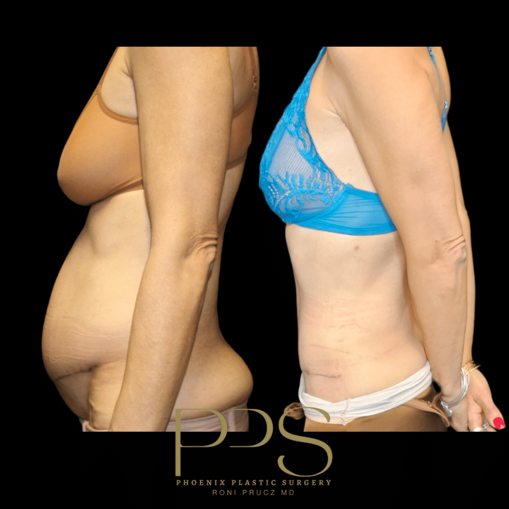 Lateral View of Tummy Tuck Revision After Botched Surgery By Another Surgeon Scottsdale Arizona