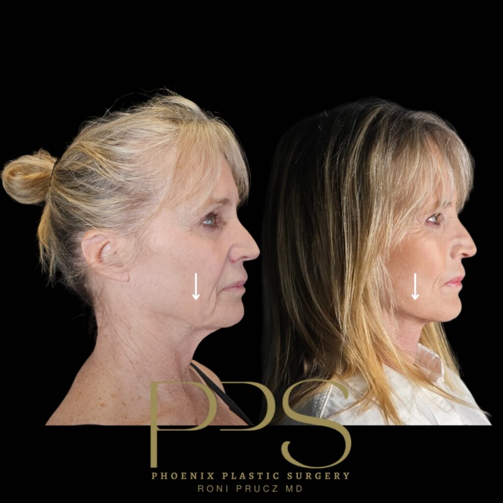 Lateral View of Female Who Underwent Facelift and Necklift Scottsdale Arizona