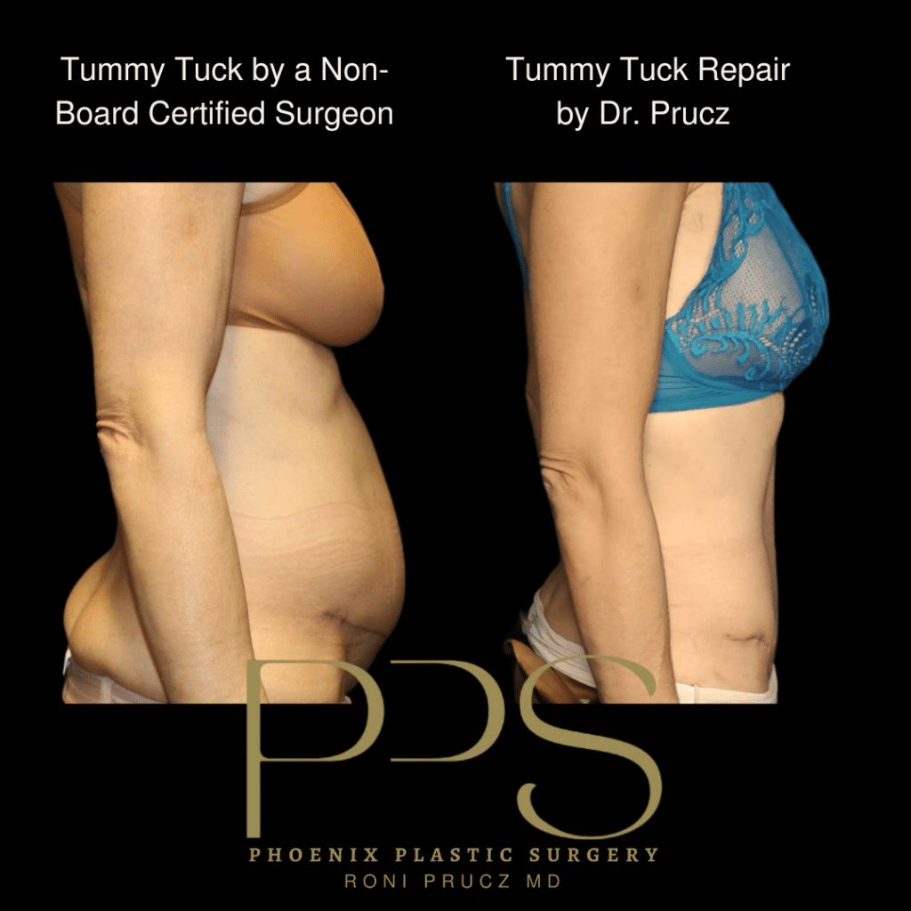 Lateral View of Tummy Tuck Revision After Botched Surgery By Another Surgeon Phoenix Arizona