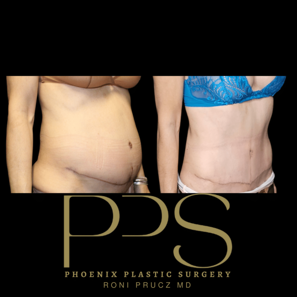 Oblique View of Tummy Tuck Revision After Botched Surgery By Another Surgeon Phoenix Arizona