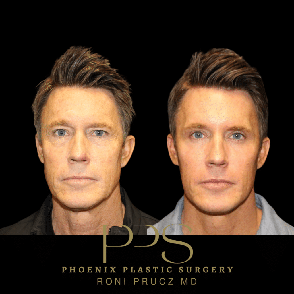 Anterior Photograph of Middle Age Male Who Had Upper and Lower Eyelid Surgery Phoenix Plastic Surgery
