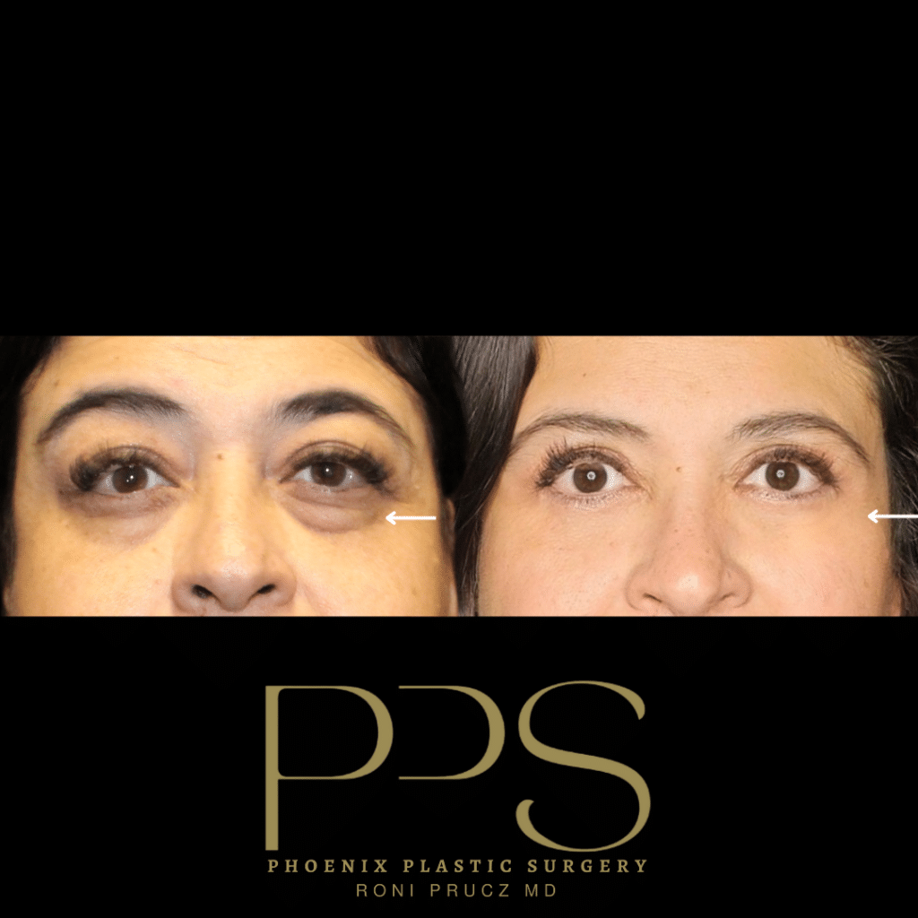 Close Up Anterior Photograph of Female Who Had Upper and Lower Eyelid Surgery Scottsdale Arizona