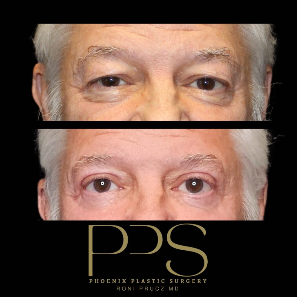 Close Up Anterior Photograph of Male Who Had Upper and Lower Eyelid Surgery Scottsdale Arizona