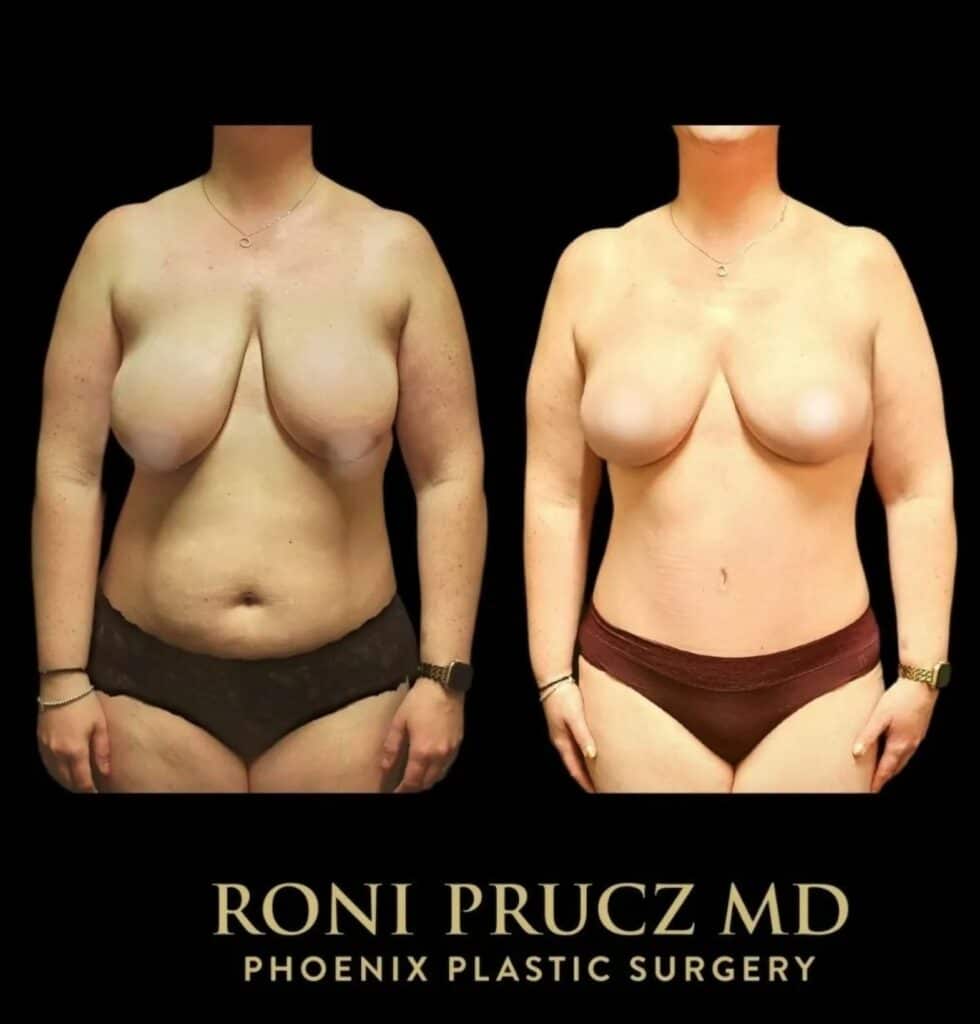 Before and After Photo of Mommy Makeover with Breast Lift and Abdominoplasty Phoenix Arizona