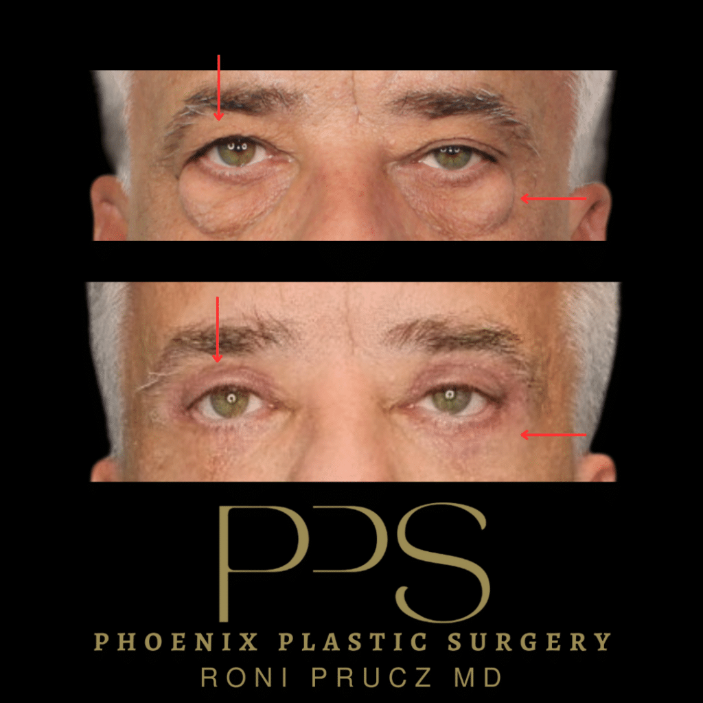 Before and After Photo of Male Upper and Lower Blepharoplasty Scottsdale Arizona