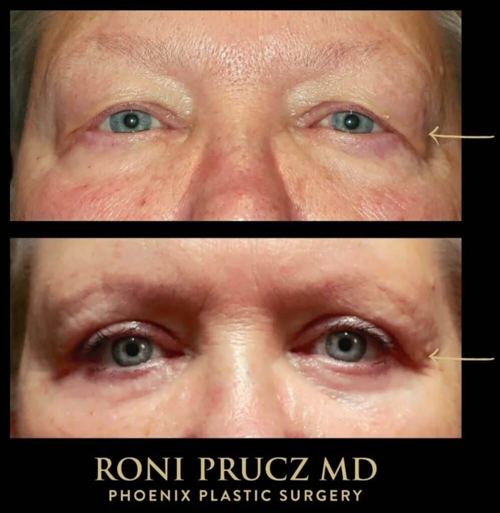 Before and After Photo of Female Eyelid Surgery Scottsdale Arizona