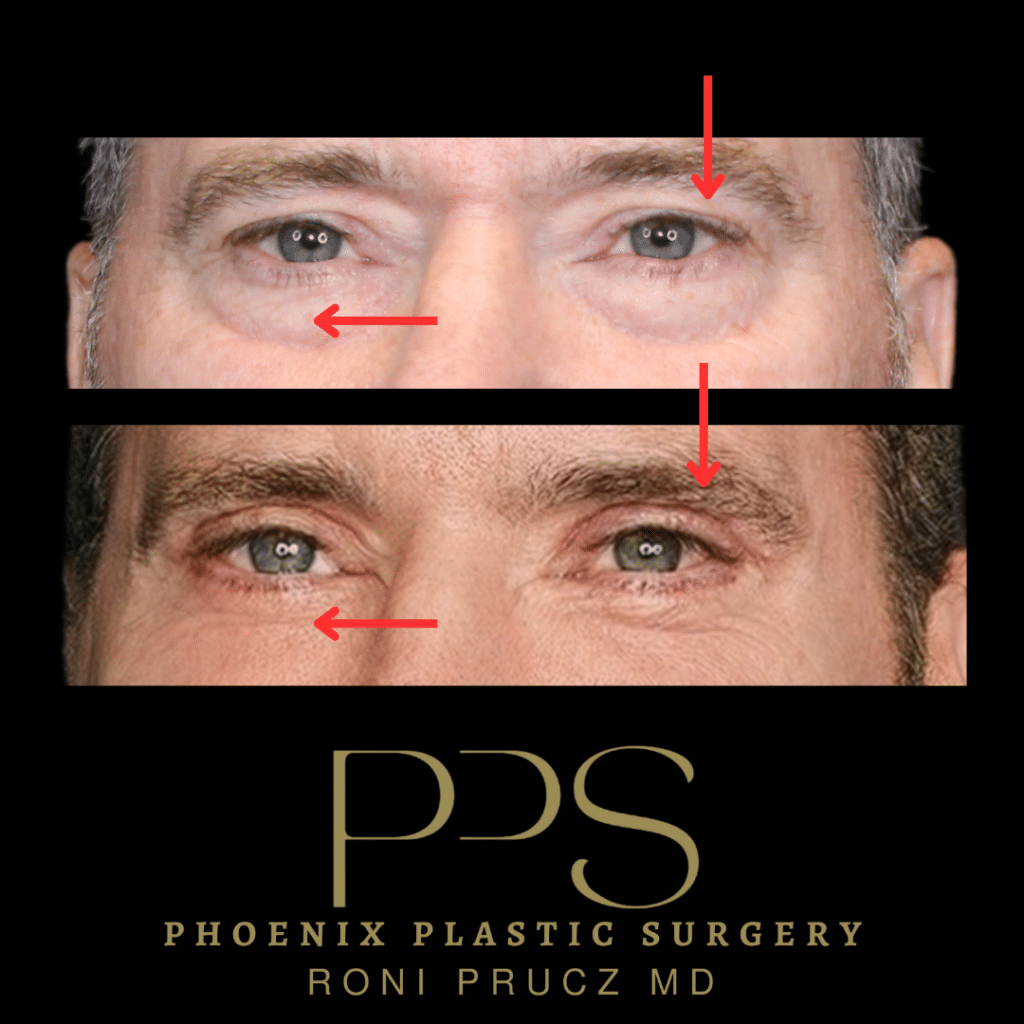 Before and After Photo of Male Upper and Lower Blepharoplasty Scottsdale, Arizona