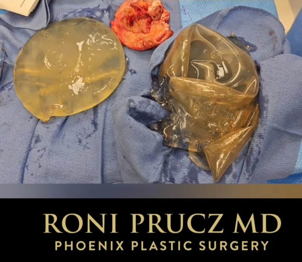 Ruptured Silicone Implants After Implant Removal with Capsulectomy Phoenix Arizona