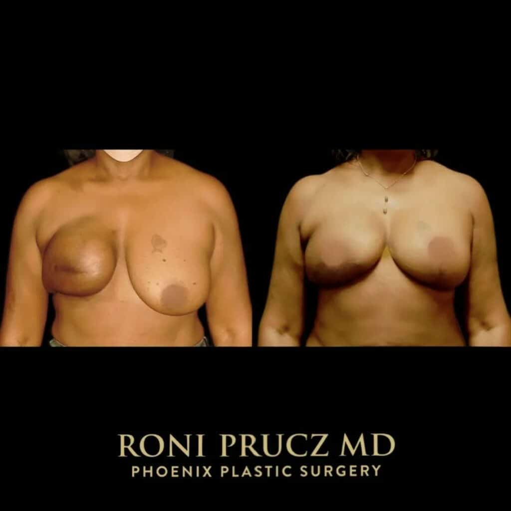 Before and After Photo Left Breast Mastopexy for Matching Procedure Scottsdale Arizona