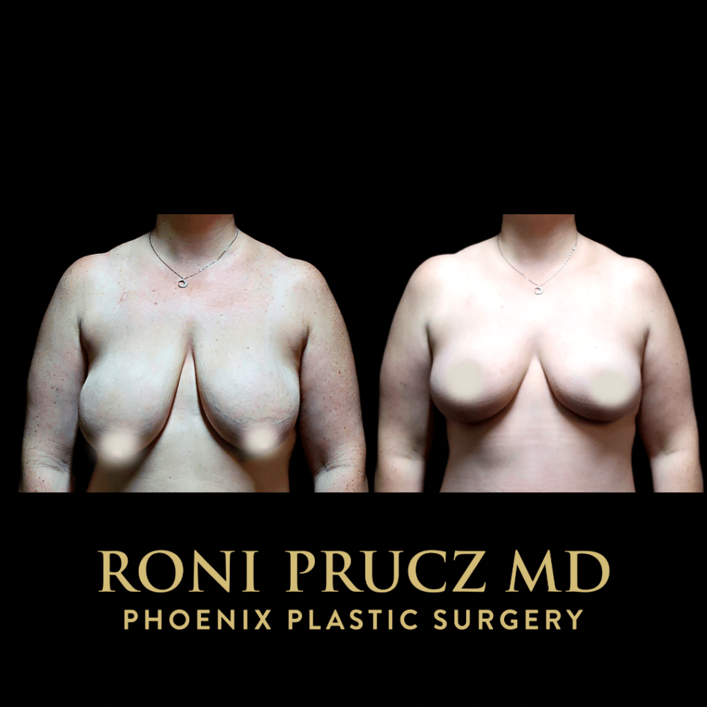Before and After Breast Lift Breast Reduction Scottsdale Arizona