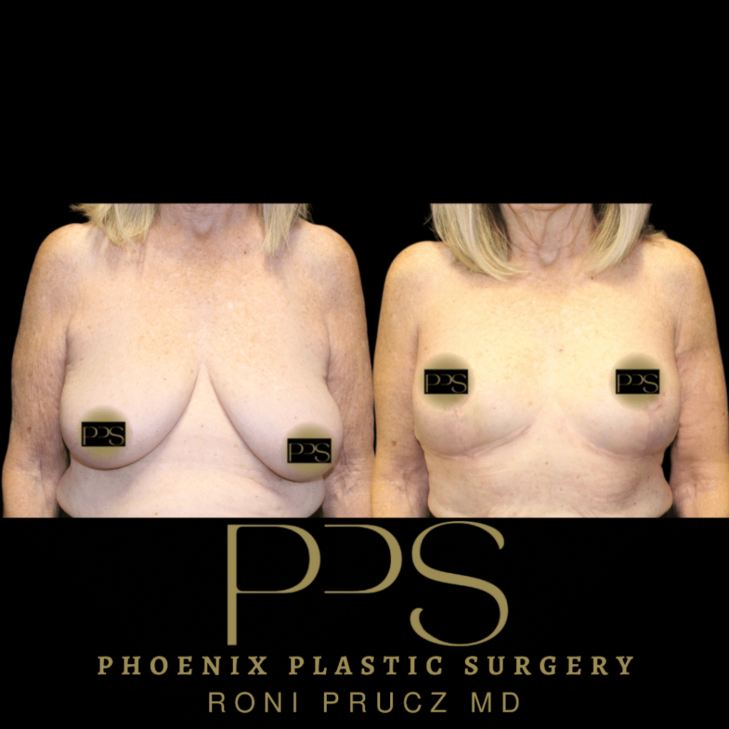 Before and After Photo of Breast Lift with Implants Phoenix Arizona
