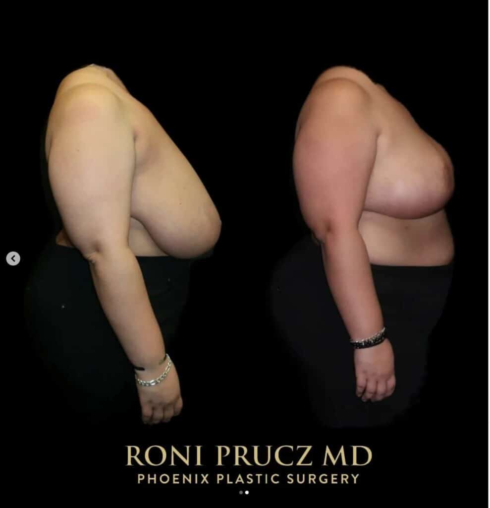 Before and After Large Breast Reduction Phoenix Arizona