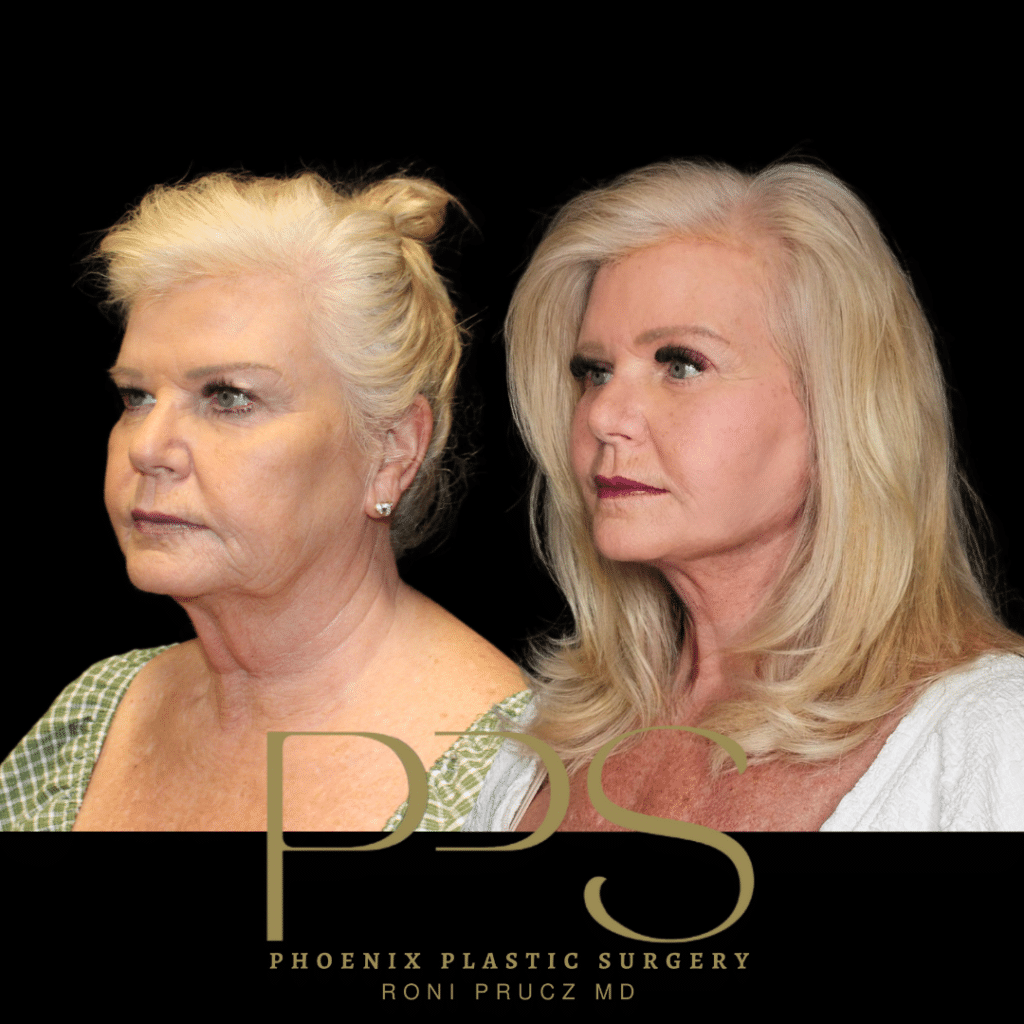 Before and After Photos of Women who had Eyelid Surgery, Brow Lift, Face Lift, and Neck Lift in Phoenix Arizona
