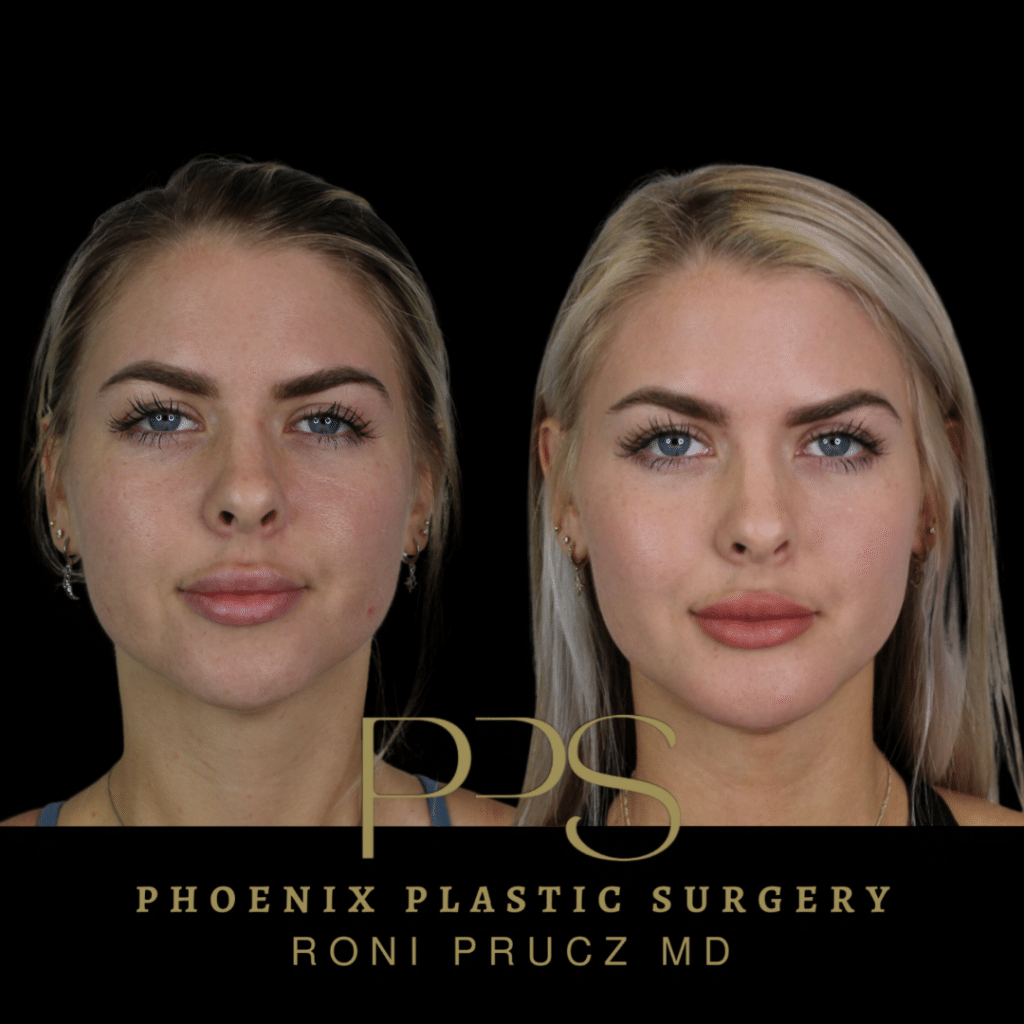 Before and After Photo of Chin Implant in Young Woman in Phoenix Arizona