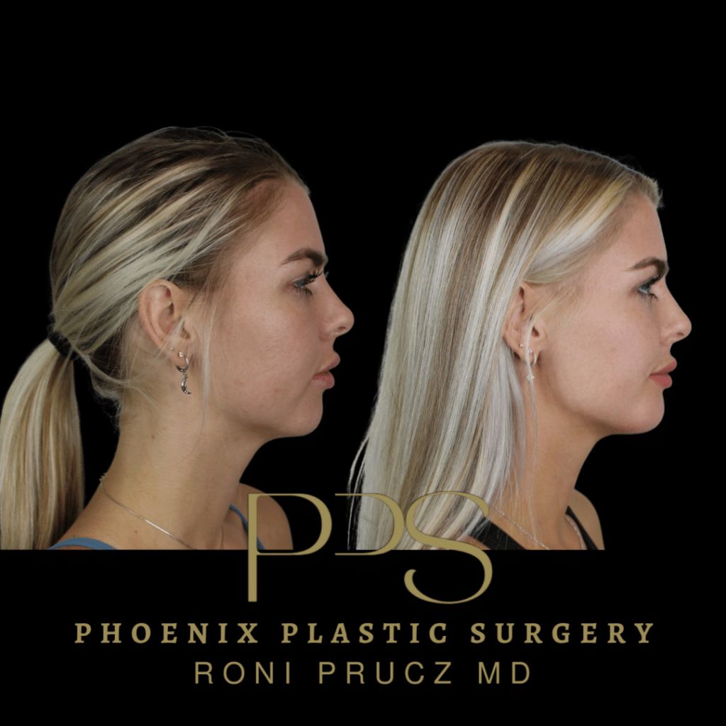 Before and After Photo of Chin Implant in Young Woman in Phoenix Arizona