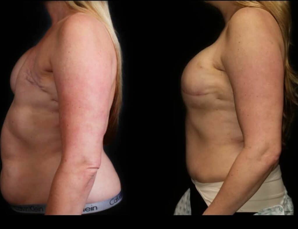 Before and After Photo of Breast after Reconstruction using DIEP Free Flap