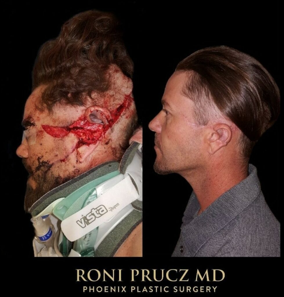 Before and After Photo Left Ear and Face Laceration Reconstruction Phoenix Arizona