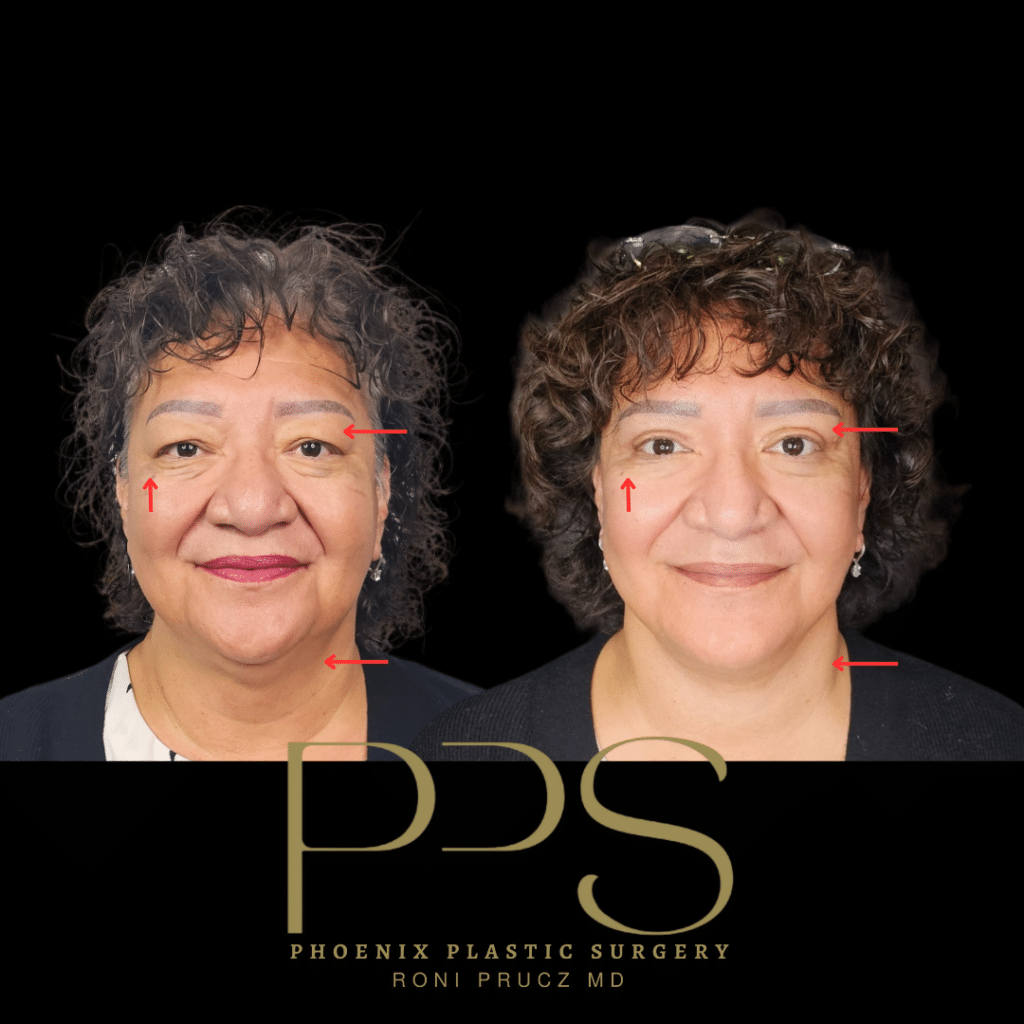Before and After Photos of Women who had Blepharoplasty, Face Lift, and Neck Lift in Scottsdale Arizona