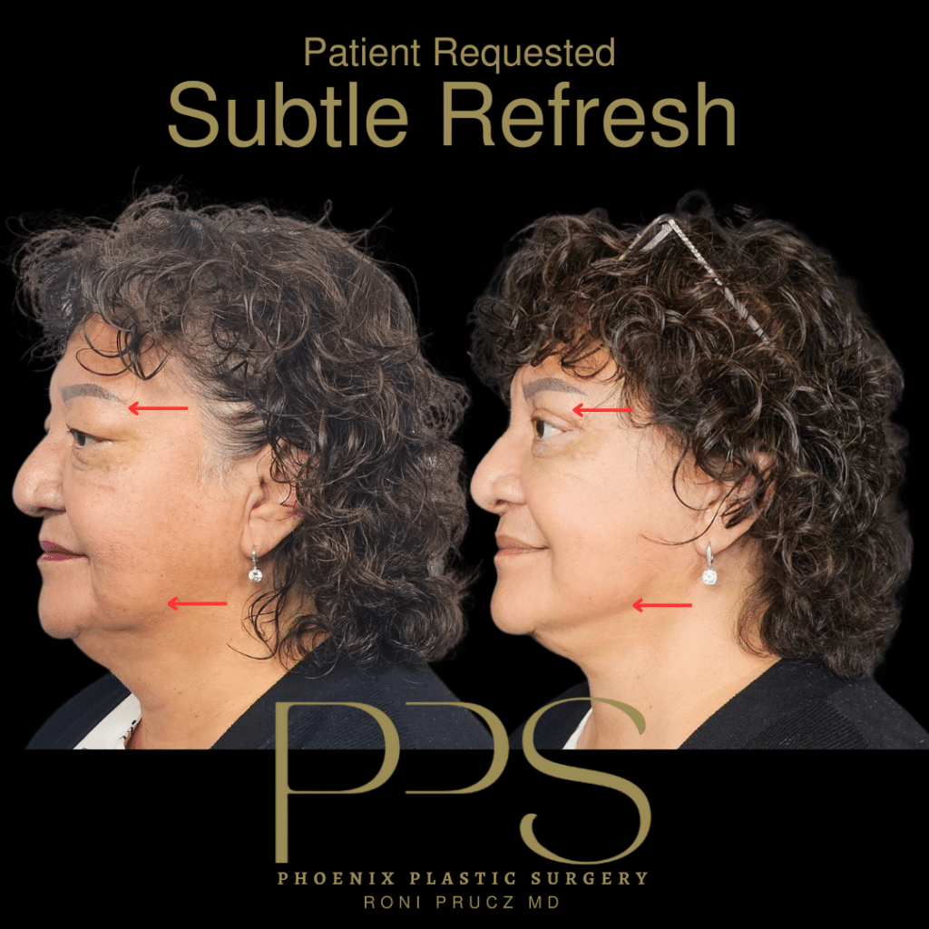 Before and After Photos of Women who had Blepharoplasty, Face Lift, and Neck Lift in Scottsdale Arizona
