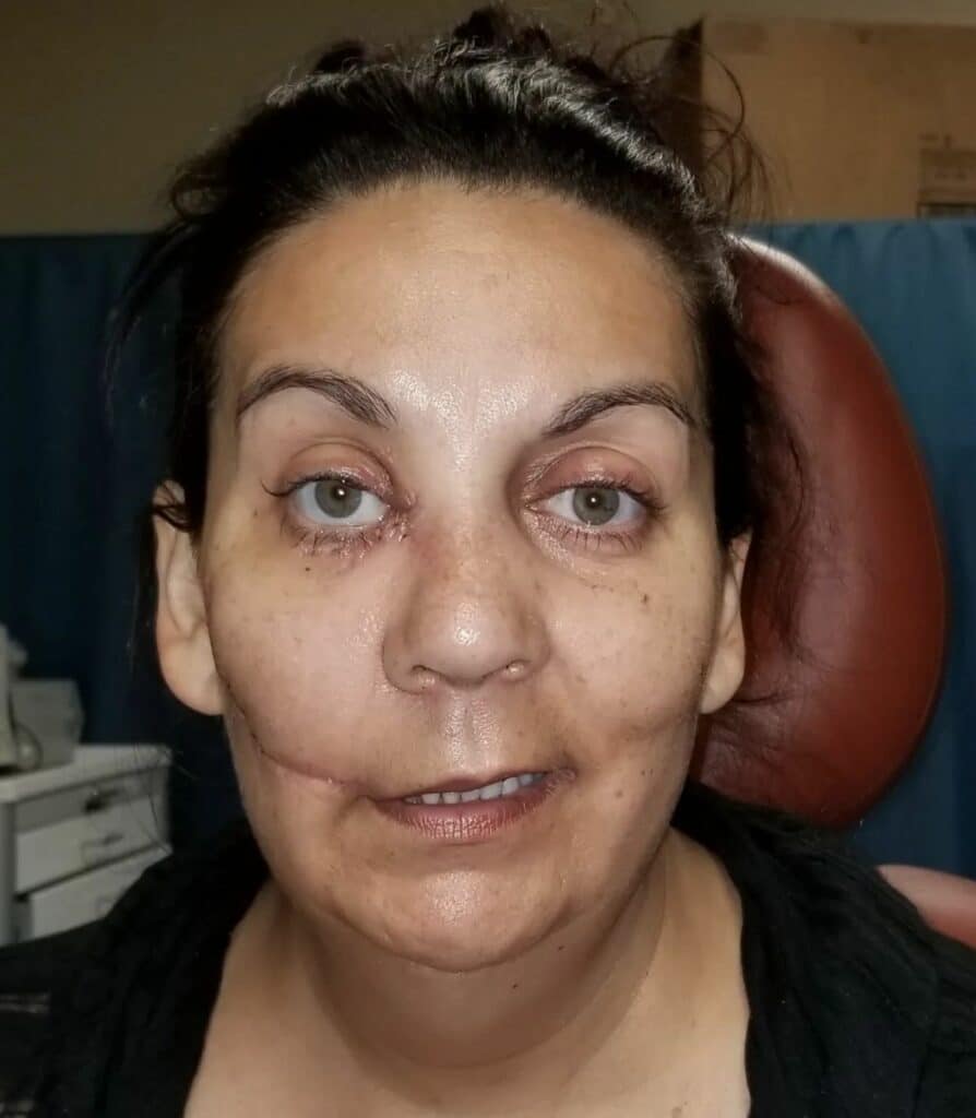 Postoperative photo of female after repair of facial avulsion