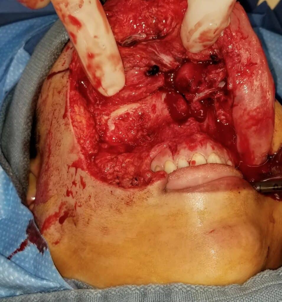 Exposed maxilla and nasal passages after traumatic facial avulsion