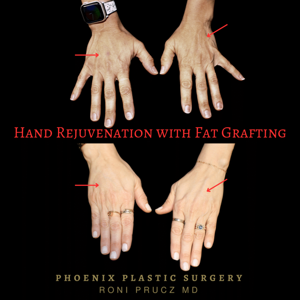 Before and after photo of fat grafting to the bilateral hands to make them appear more youthful phoenix arizona