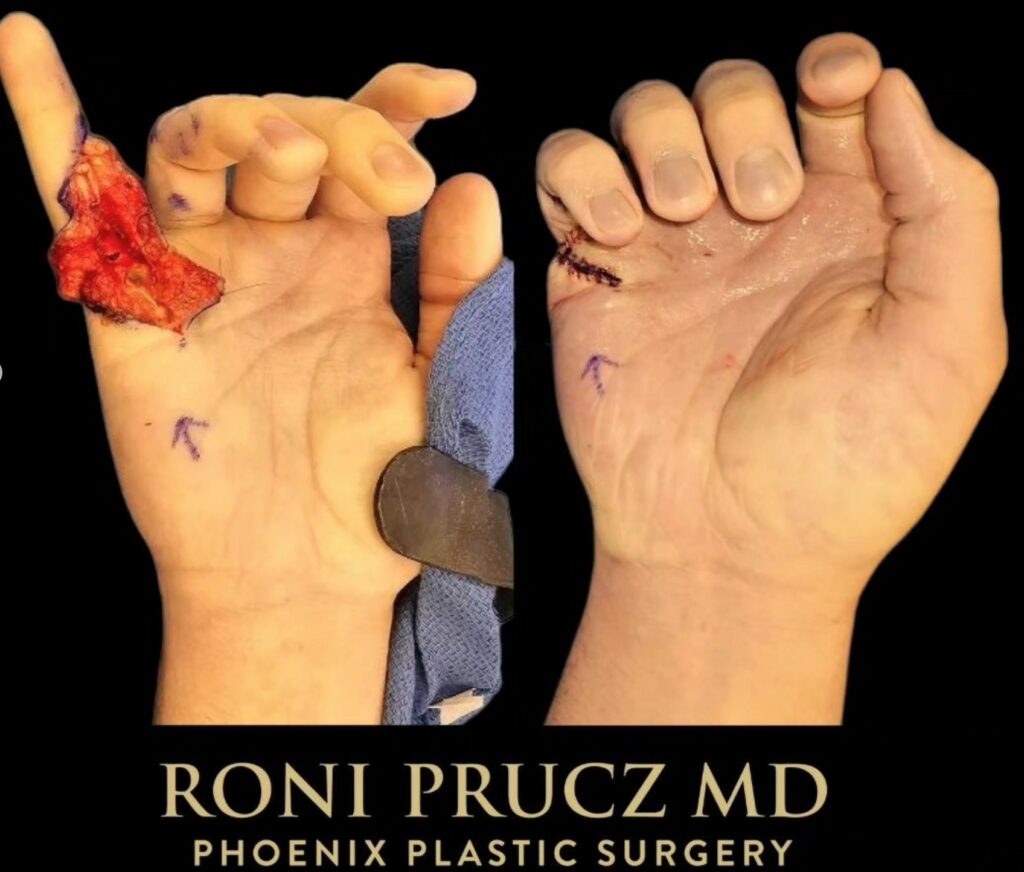 Before and After Photo Right Small Finger Flexor Tendon Repair Phoenix Arizona