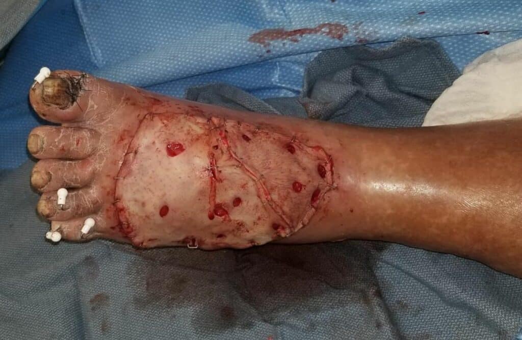Left dorsal foot wound reconstruction with free muscle flap and full thickness skin graft