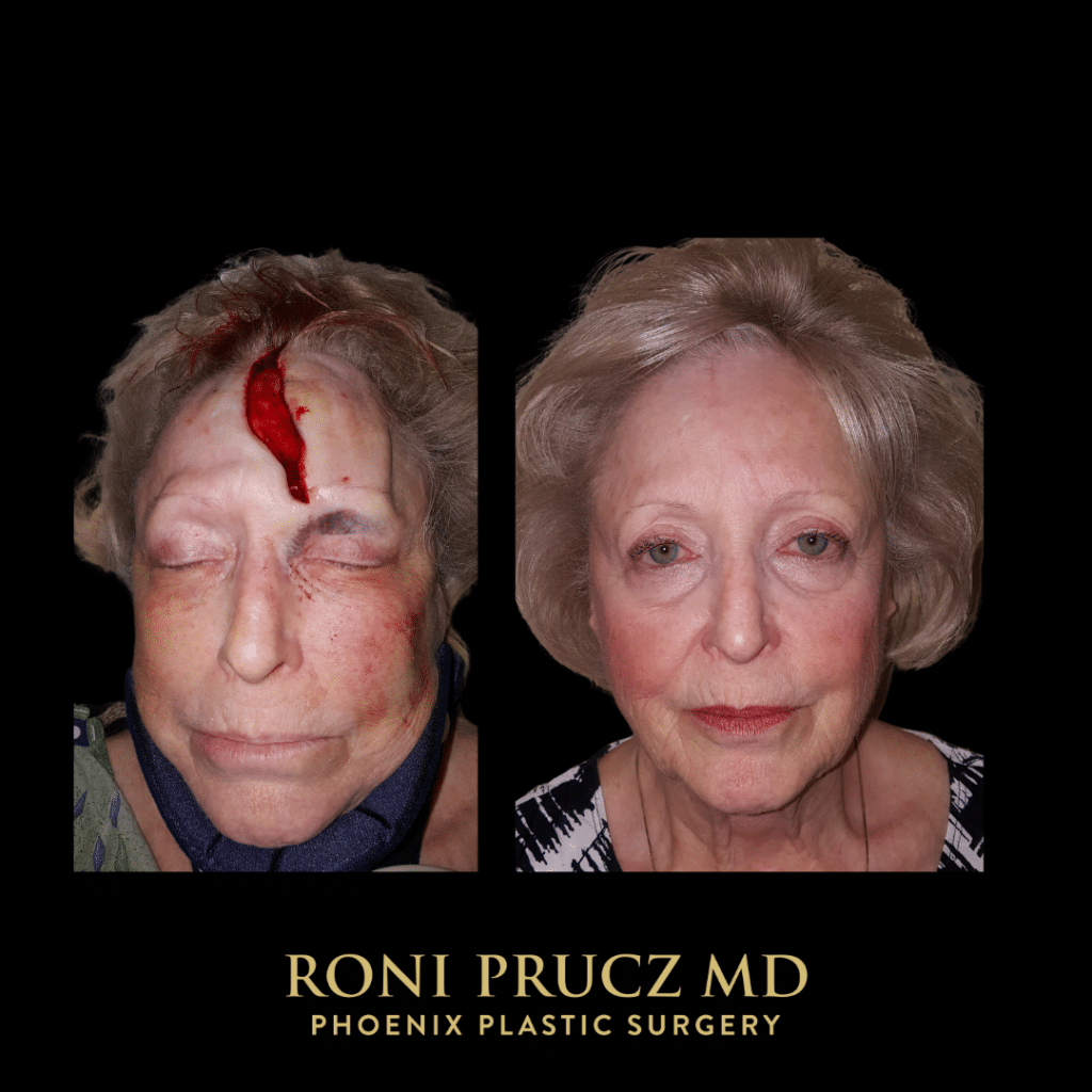 Before and after photo of forehead scar revision in Scottsdale, Arizona