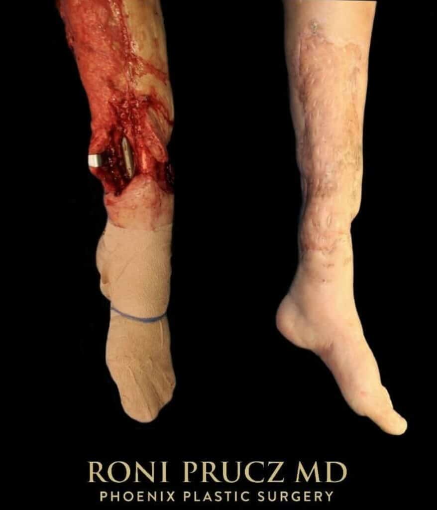 Before and After Left Leg Reconstruction with Gracilis Muscle Flap and Skin Graft Phoenix Arizona