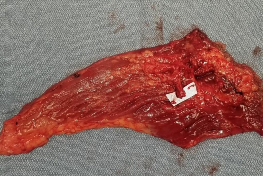 Free Latissimus Muscle Flap with Blood Vessel Pedicle Prior to Transfer