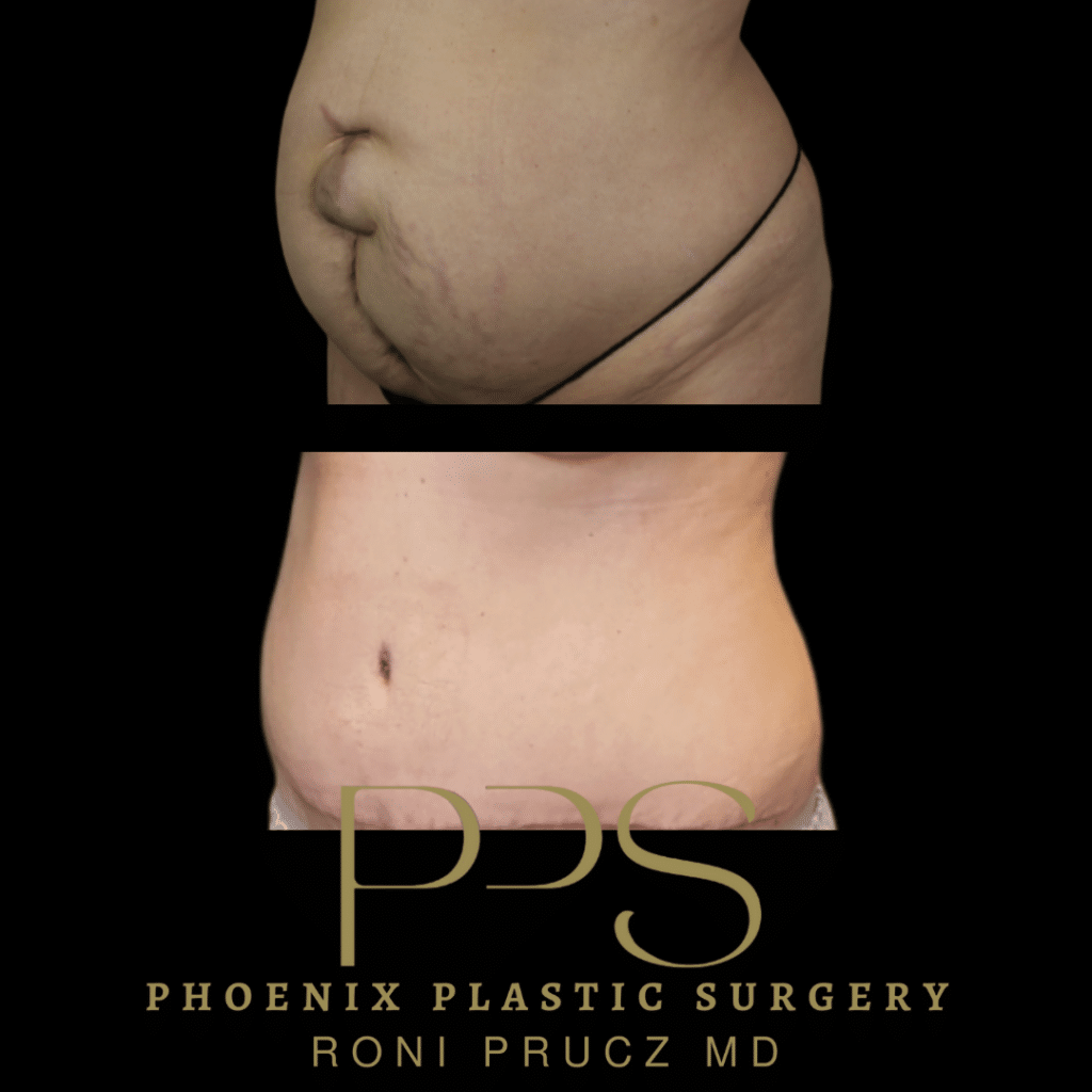 Before and after tummy tuck with hernia repair scottsdale arizona