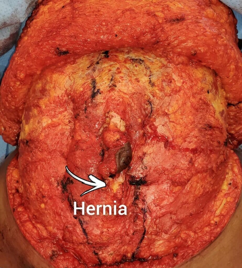 Intraoperative View of Umbilical Hernia During Abdominoplasty Scottsdale Arizona