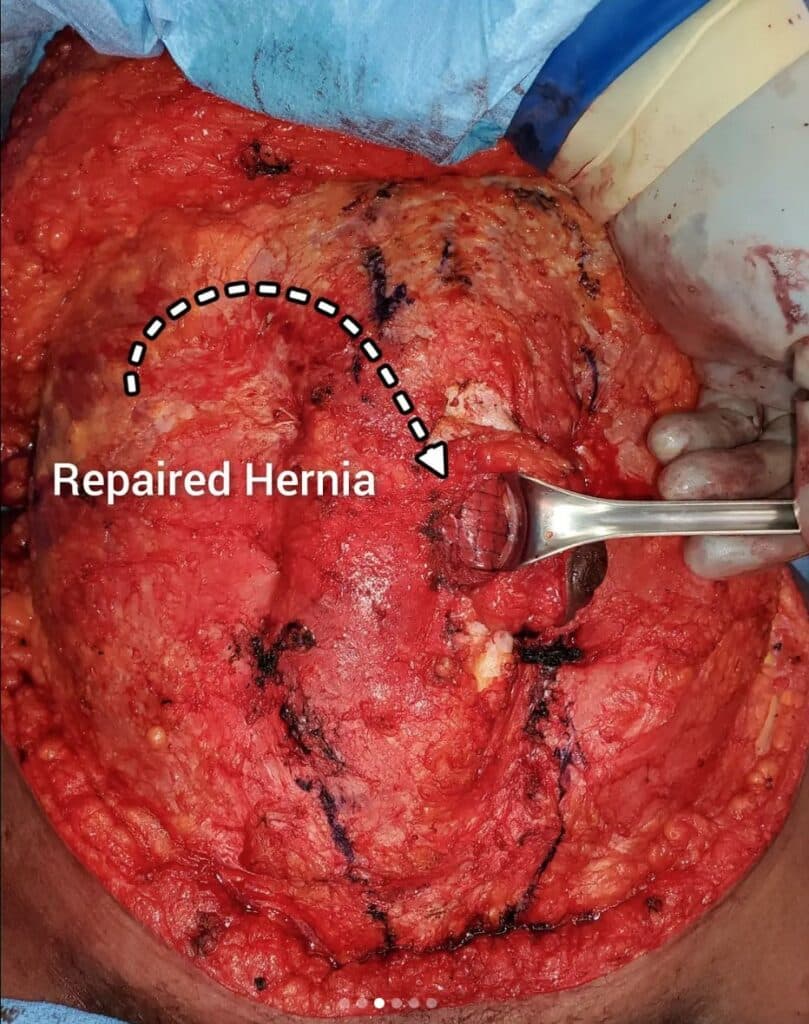 Intraoperative View of Umbilical Hernia Repair During Tummy Tuck PhoenixArizona