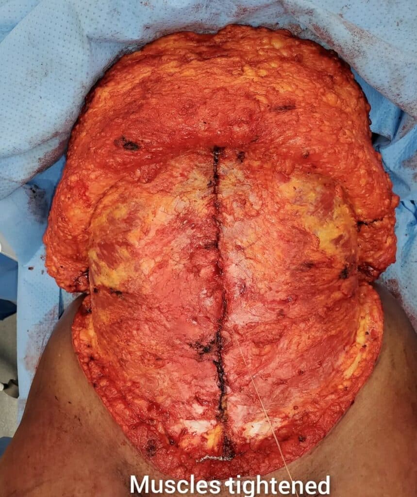 Intraoperative View of Umbilical Hernia Repair and Rectus Plication During Tummy Tuck Scottsdale Arizona