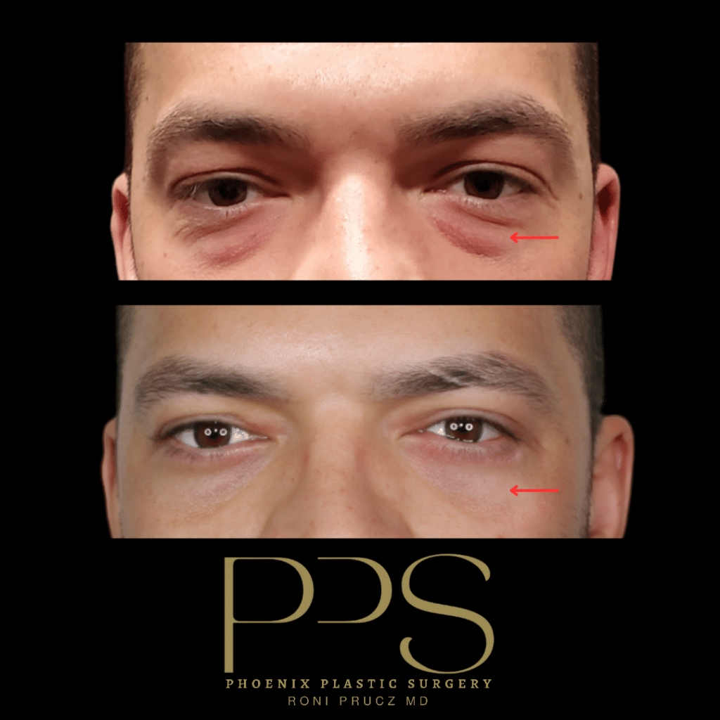 Before and After Photo of Male Upper and Lower Eyelid Surgery Phoenix Arizona