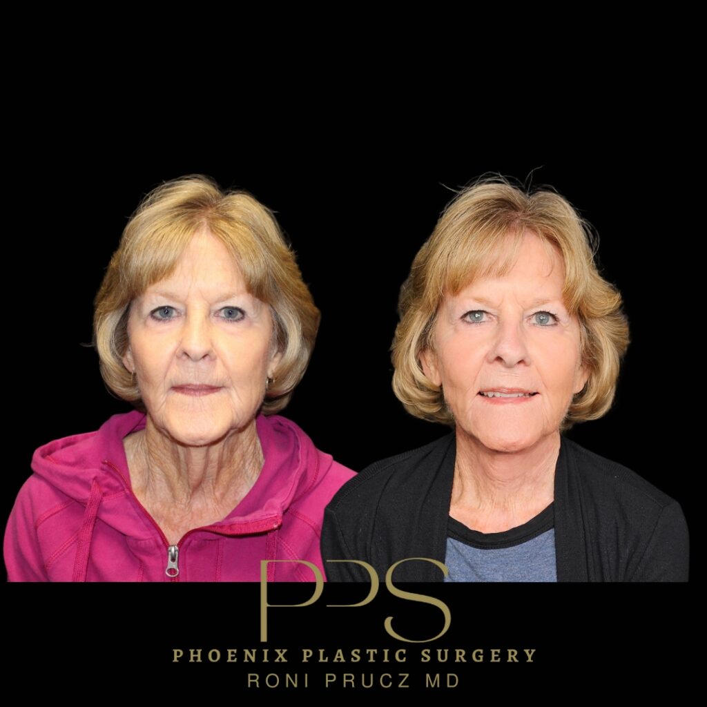 Before and After Photo of Female Neck Lift at Phoenix Plastic Surgery