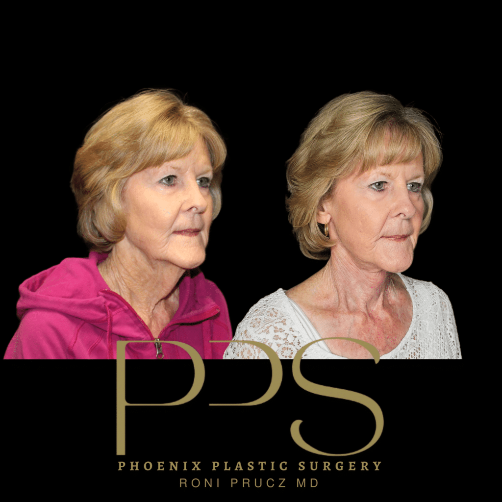 Before and After Oblique Photo of Female Neck Lift at Phoenix Plastic Surgery in Phoenix Arizona