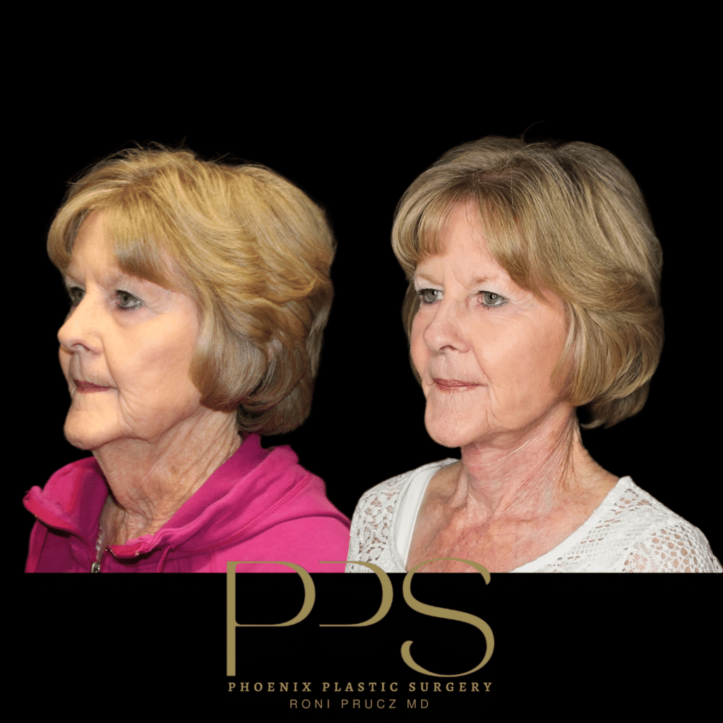 Before and After Oblique Photo of Female Neck Lift at Phoenix Plastic Surgery