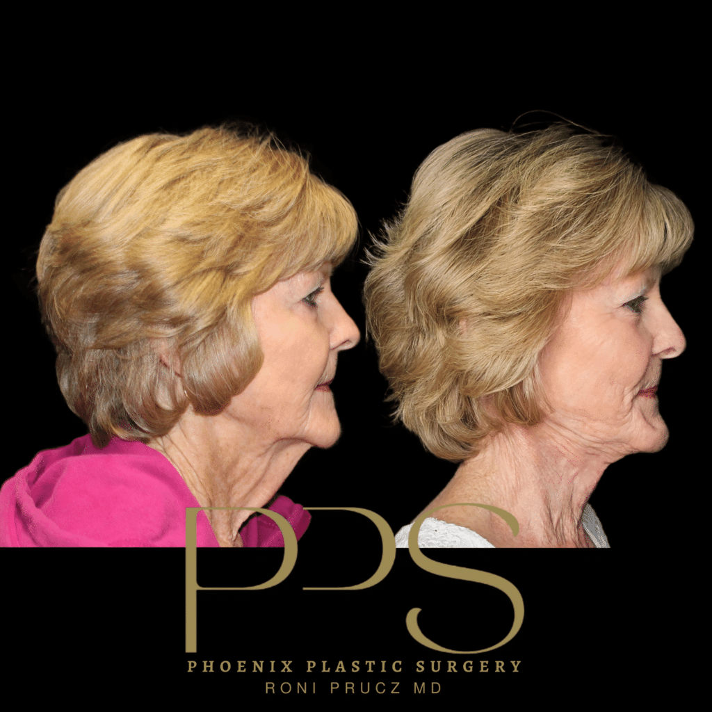 Before and After Side Photo of Female Neck Lift at Phoenix Plastic Surgery in Paradise Valley Arizona