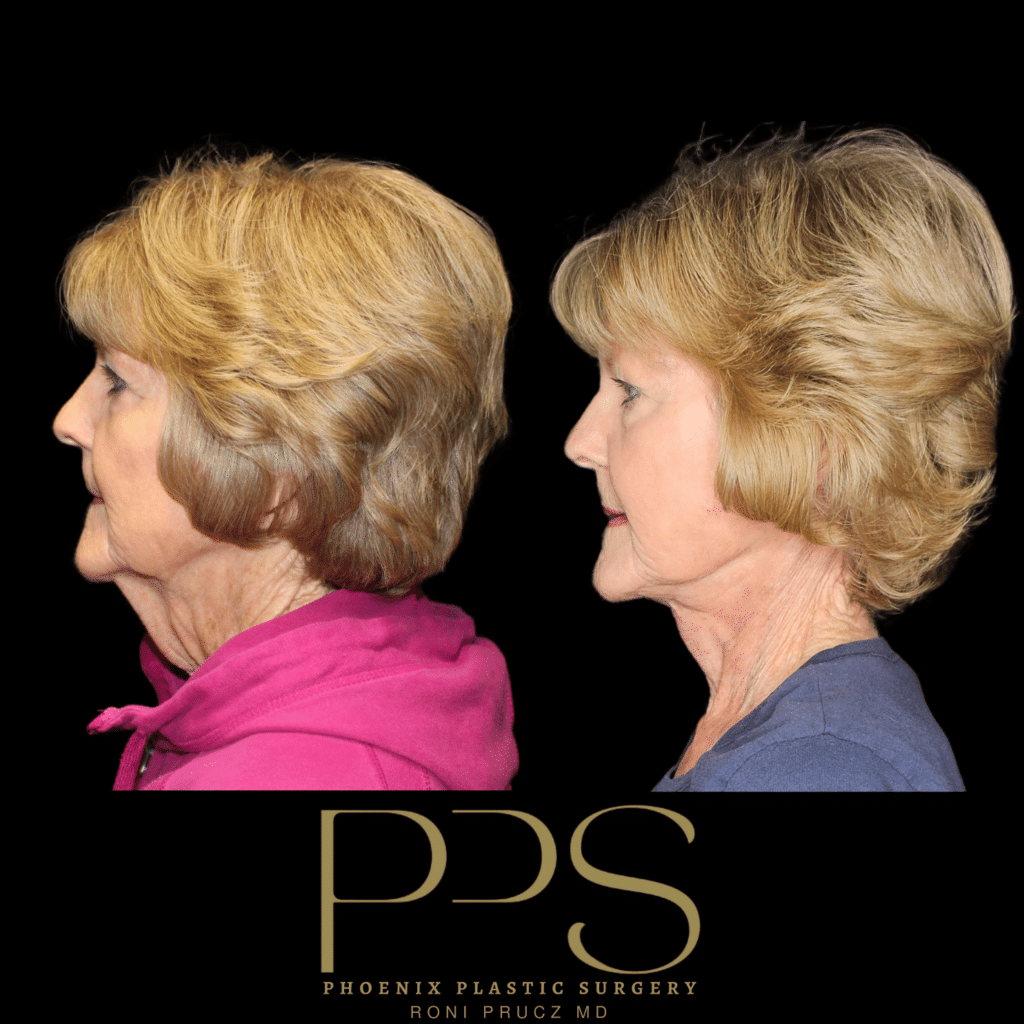 Before and After Side Photo of Female Neck Lift at Phoenix Plastic Surgery in Scottsdale Arizona