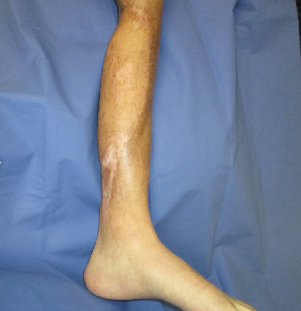 Postoperative Photo Left Leg Sarcoma Defect with Exposed Bone After Reconstruction Using Anterolateral Free Flap Phoenix Arizona