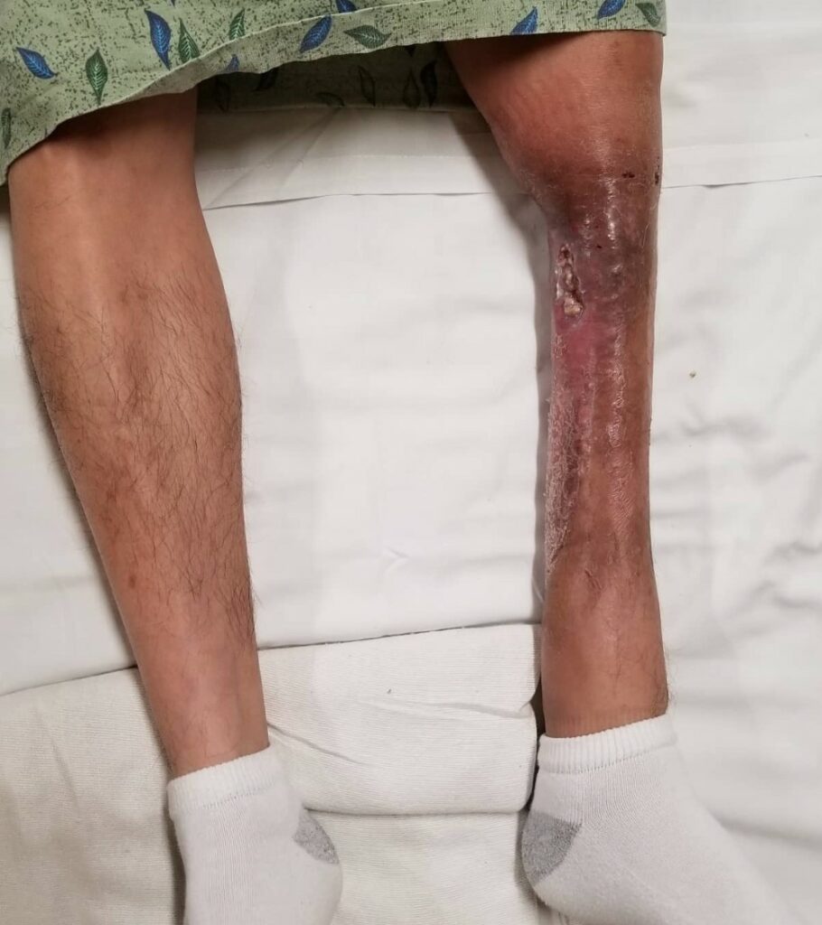 Preoperative Photo Left Leg Sarcoma Defect with Exposed Bone Phoenix Arizona