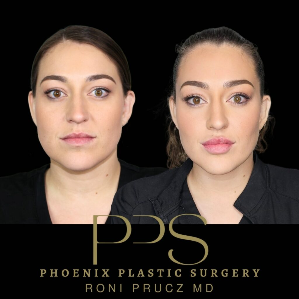 Before and After photo of lip and nasolabial fillers in phoenix arizona