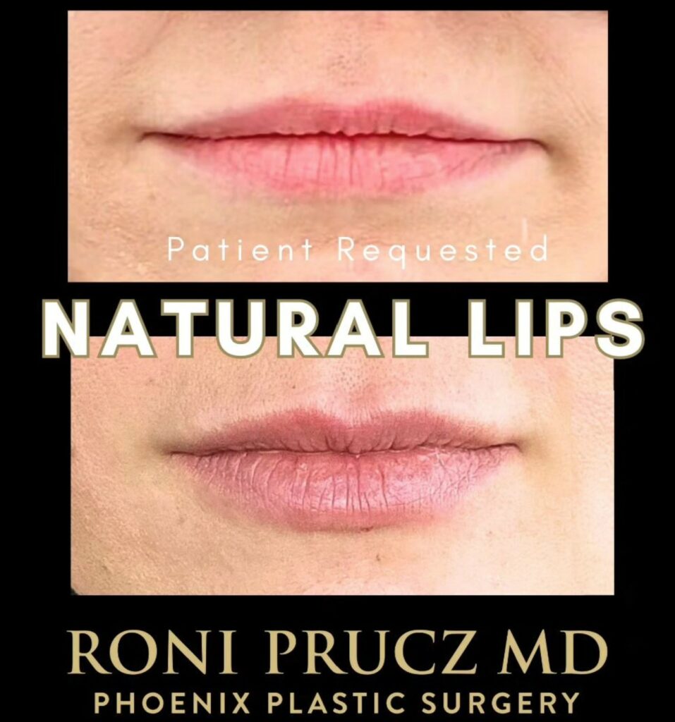 Before and After Photo Lip Augmentation with Filler Phoenix Arizona