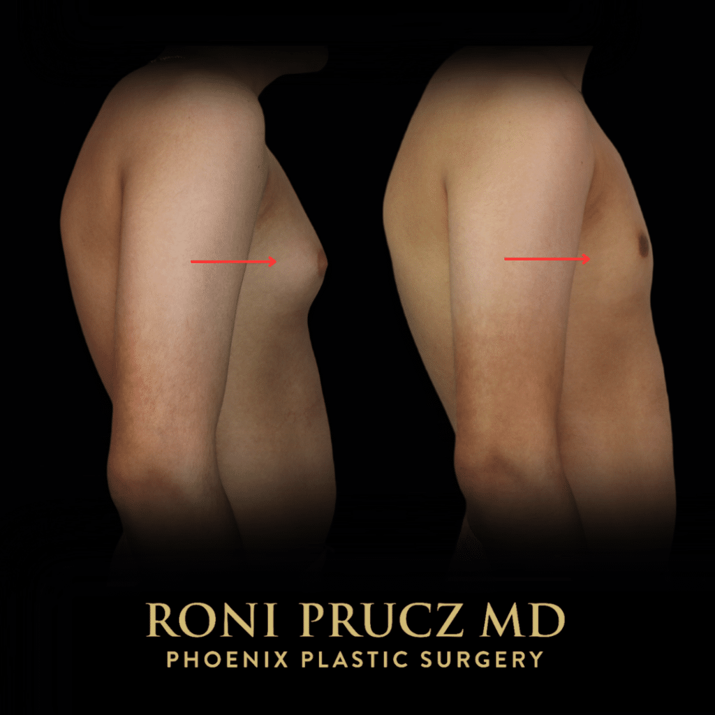 Before and After Photo Male Gynecomastia Correction with Surgery and Liposuction Scottsdale Arizona